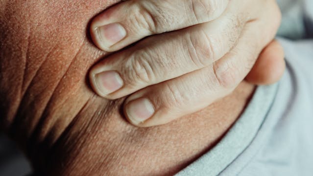 person applying heat rash treatment cooling remedy to irritated skin